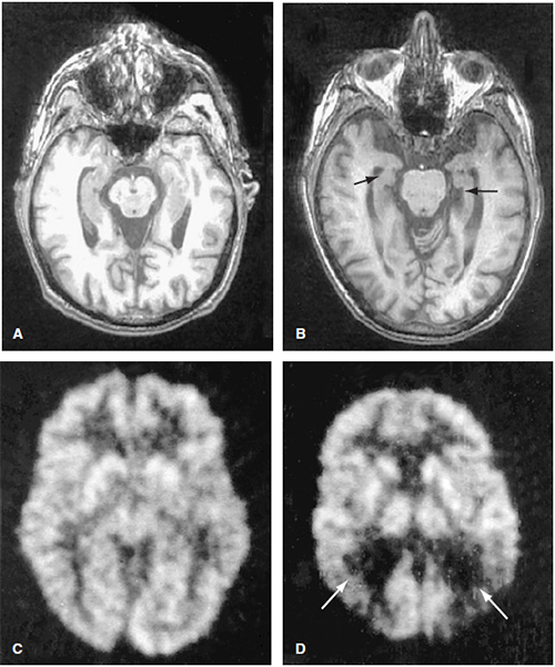 Alzheimer disease