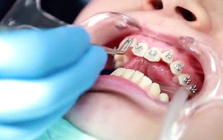 Niềng răng xong bị hở lợi - Cần khắc phục ngay-3