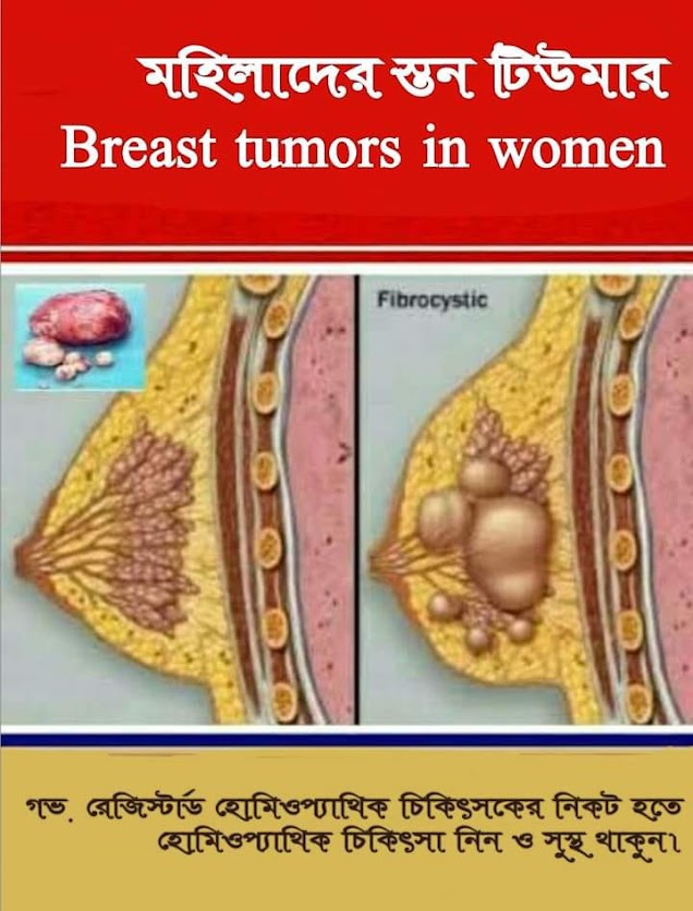 স্তন টিউমার ও স্তন ক্যান্সারে হোমিওপ্যাথি চিকিৎসা