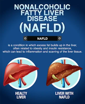 Symptoms and Signs of Nonalcoholic Fatty Liver Disease- healthy bel