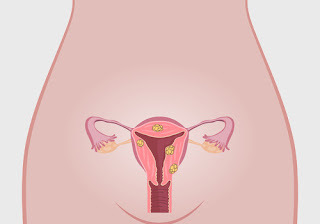 What is Uterine Fibroid