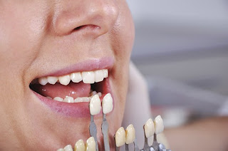 Trồng răng implant cho răng cửa-1