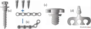 Types of Mini implants Temporary anchorage devices (TADs)