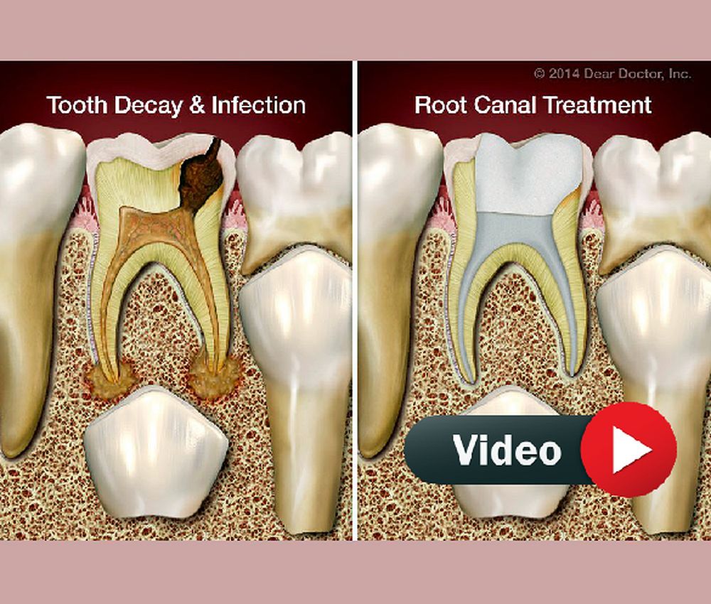 Pulpectomy