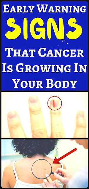9 warning signs and symptoms of cancer that we usually ignore