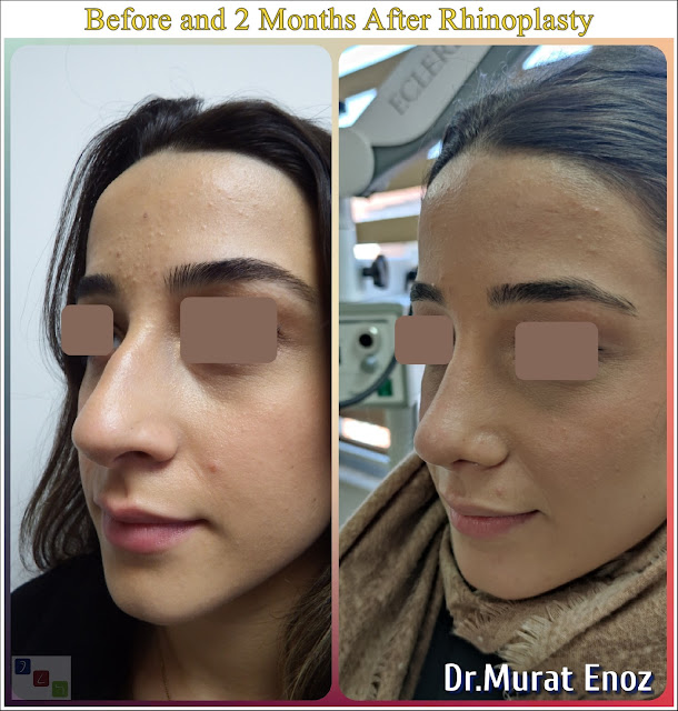 Before and 2 months after nose aesthetic operation - natural rhinoplasty - nose job istanbul