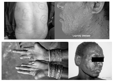 Symptoms of Leprosy
