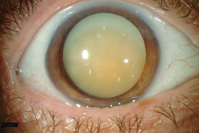 Cataract: Types, symptoms and treatment