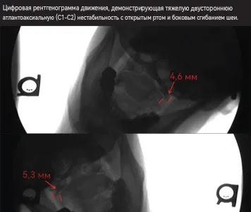 Расположение и отношение между субокципитальными мышцами к позвонку С1 - Атланту, и позвонку С2 - оси и пути прохождения затылочного нерва.