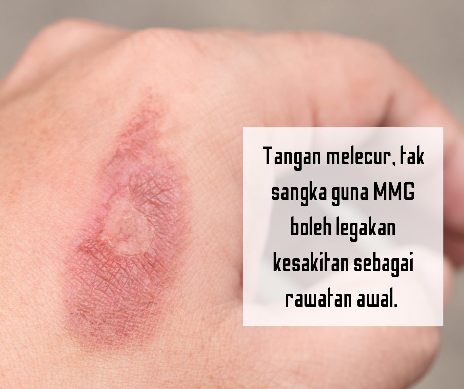 Tangan melecur, tak sangka guna MMG boleh legakan kesakitan sebagai rawatan awal.