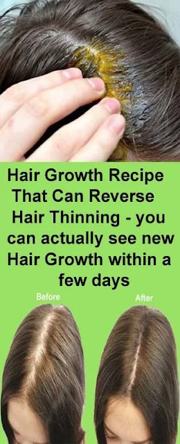 Ultimate Hair Growth Recipe – That Can Reverse Hair Thinning in Short Time !