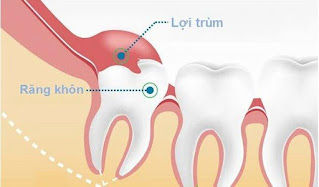 Mối nguy hại từ bệnh viêm lợi trùm răng số 8-1