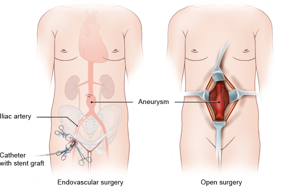 Quando a cirurgia é indicada para o tratamento do aneurisma da aorta abdominal ?