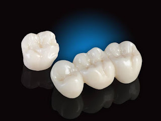 Tiêu chuẩn cơ sở làm răng sứ cho răng hô uy tín-1