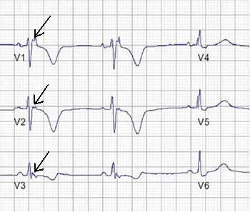 Ref: ESC, Diagnosis and management of arrhythmogenic right ventricular dysplasia
