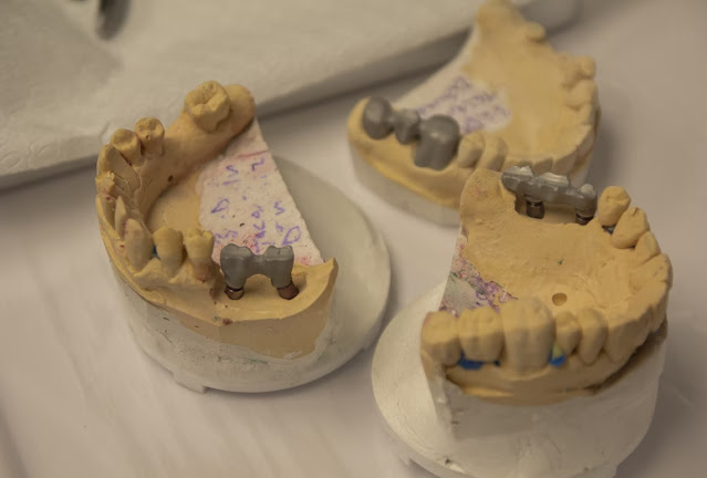 Provini protesici che servono a calcolare la posizione degli impianti dentali