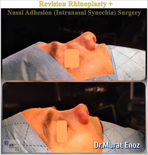 Intranasal Synechia, Revision Nose Job in Men Istanbul,Complicated Secondary Revision Rhinoplasty, Nasal Septal Spur Removal,bone spur formation,