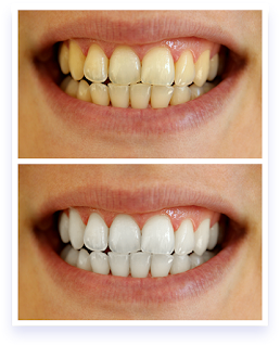 Teeth Whitening Methods(MustRead)#