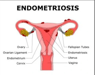 What is endometriosis symptoms What are the risk factors and treatment of endometriosis?एंडोमेट्रियोसिस क्या है लक्षण एंडोमेट्रियोसिस के जोखिम कारक और उपचार क्या हैं?- ichhori.com