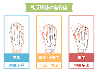 外反母趾の進行度チェックを表すイラスト。詳細は以下。