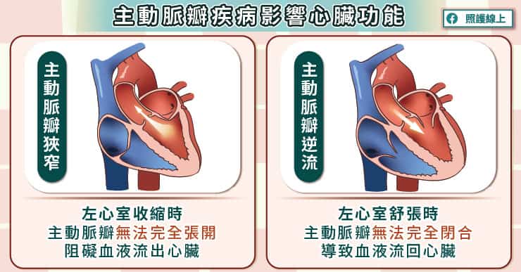 主動脈瓣閉鎖不全影響心臟功能