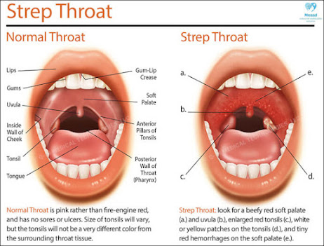 What is strep throat?