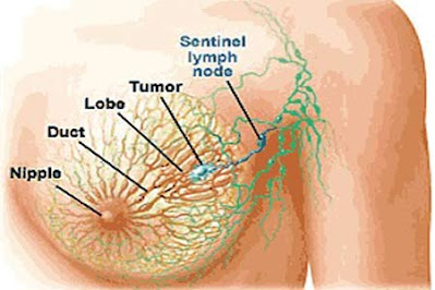 Breast Cancer Treatment Overview
