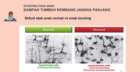 Kondisi Otak Anak Stunting - Prima Talk Akademi Keluarga Prima