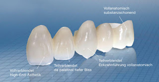 Quy trình làm cầu răng sứ -2