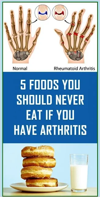 5 Foods You Should Never Eat If You Have Arthritis