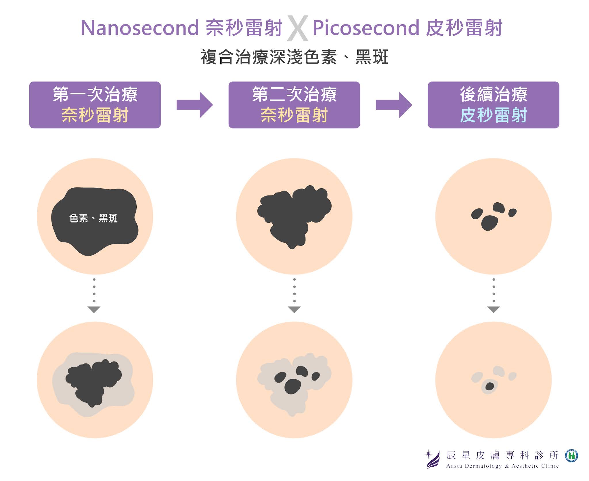 皮秒雷射治療黑斑