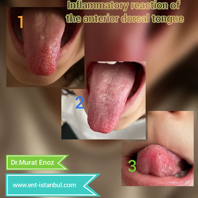 Oral Hypersensitivity, Oral Allergy, Inflammatory Reaction of Tongue, Oral Allergy Syndrome