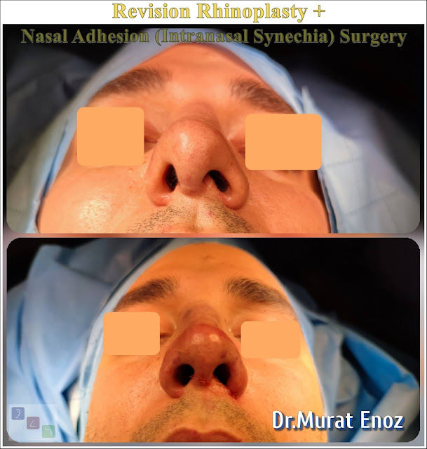 Intranasal Synechia, Revision Nose Job in Men Istanbul,Complicated Secondary Revision Rhinoplasty, Nasal Septal Spur Removal,bone spur formation,