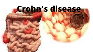 Crohn's