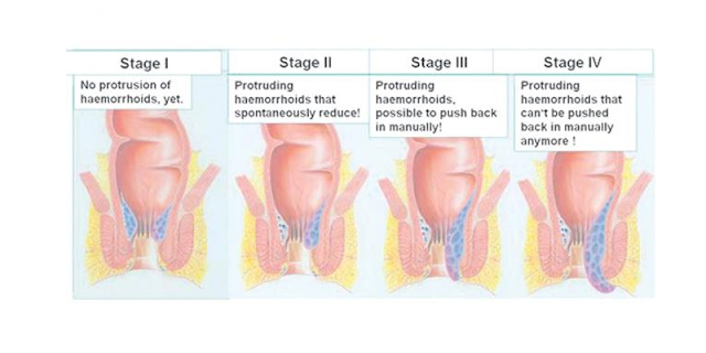 WHAT IS PILES / HEMORRHOIDS? MAIN CAUSES, REASONS, DIAGNOSIS, AND HOMOEOPATHY TREATMENT