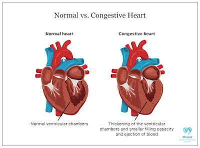 Congestive Heart Failure  dif