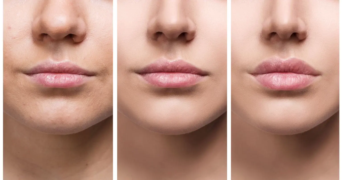 Considering Lip Fillers in NJ? Read This First!