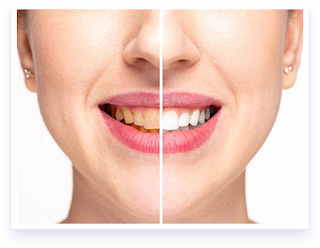 What are the Teeth Whitening Methods?