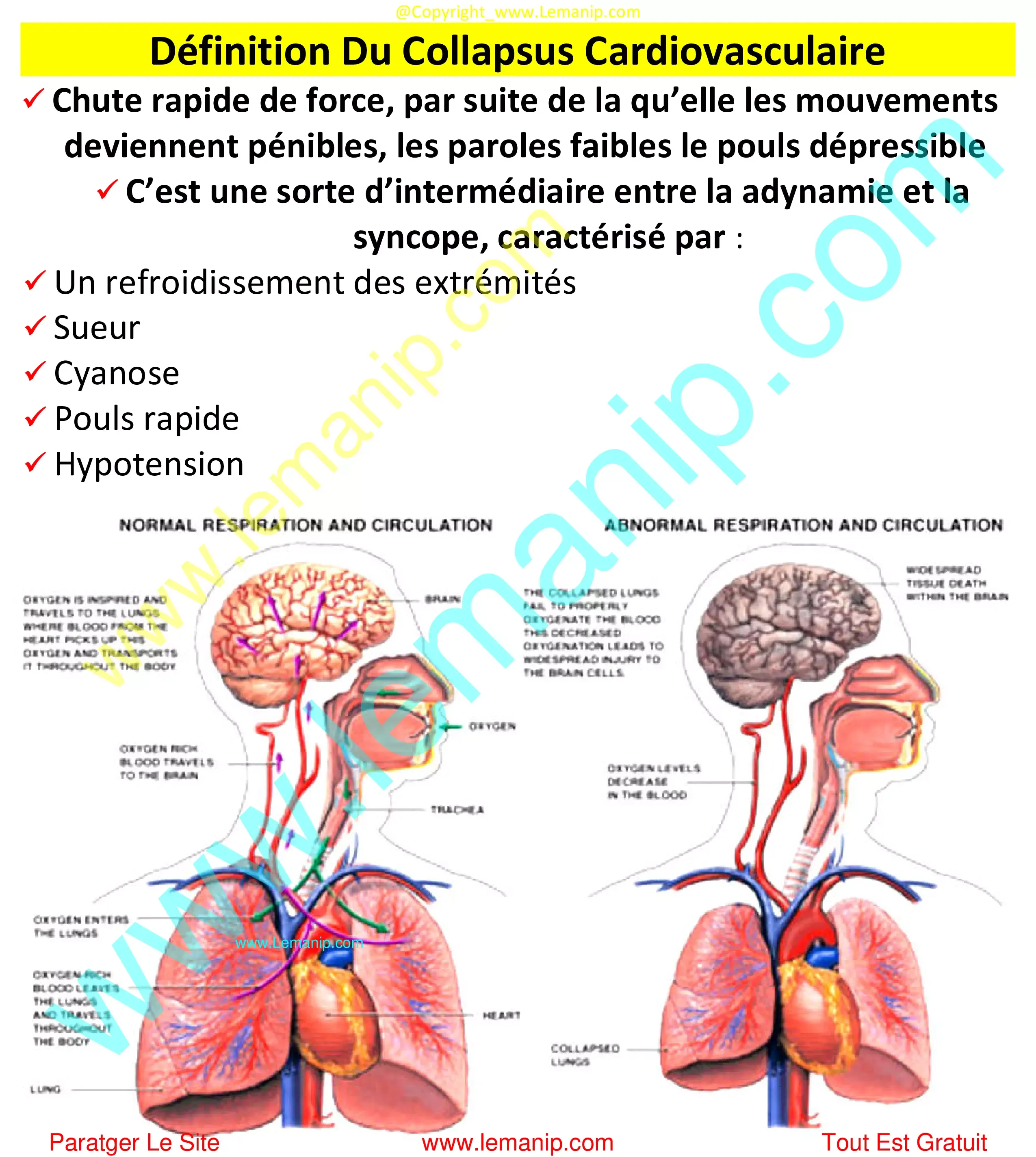 Définition Du Collapsus Cardiovasculaire