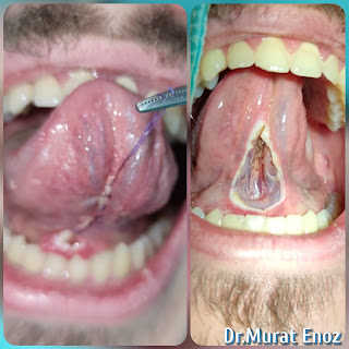 Tongue tie surgery in istanbul