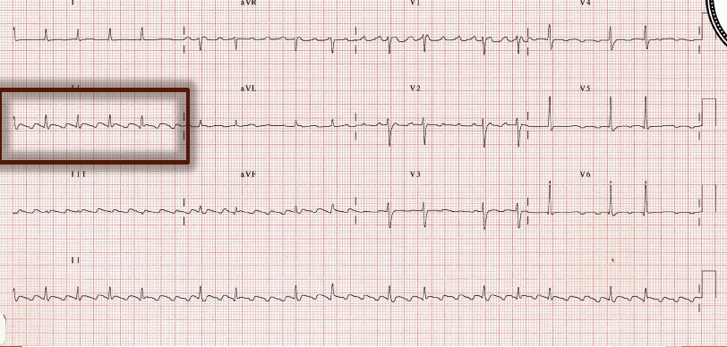 atriyal-flutter-ekg