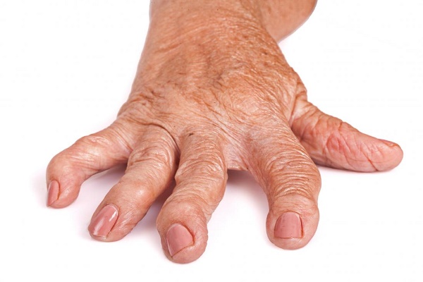 What causes arthritis in fingers