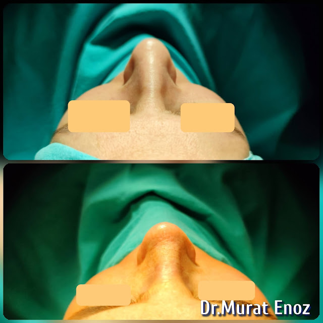 nose job,Natural rhinoplasty in Istanbul,Natural looking nasal aesthetic surgery,nose reshaping,
