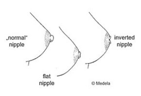 TAmpak beda antara puting yang normal dengan flat nipple
