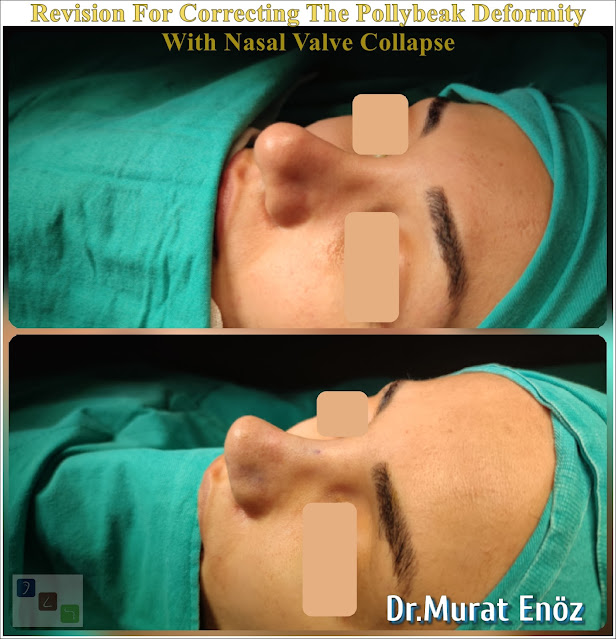 Nasal valve collapse, Pollybeak Deformity, Polly Beak Nose Deformity,