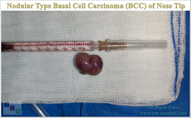 Nodular Type Basal Cell Carcinoma of Nose, BCC, Nose Tumor, Mass Lesion of Nose Tip