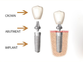 Cấy ghép răng implant là gì-1