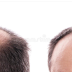 চুল পাতলা হয়ে যাওয়ার অন্যতম প্রধান কারণ হচ্ছে চুল পড়ে যাওয়া। Hair Lose Solutions | Ekushe News