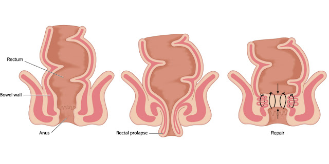 How Can You Tell the Difference Between Hemorrhoids and Rectal Prolapse?