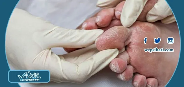 علاج الفطريات بين الأصابع بالأعشاب: هل الماء والملح يعالج الفطريات؟